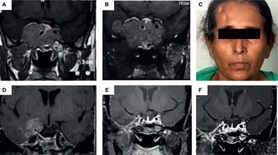 Early Initiation of Temozolomide Therapy May Improve Response in Aggressive Pituitary Adenomas